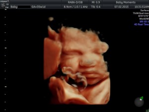 35 WKS 4d Pregnancy scan berkshire 